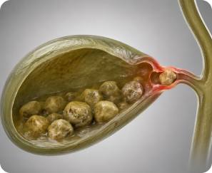 Bile Duct Stones (Choledocholithiasis)