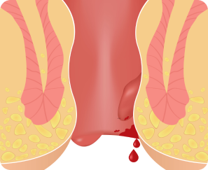 Interno-External Hemorrhoids